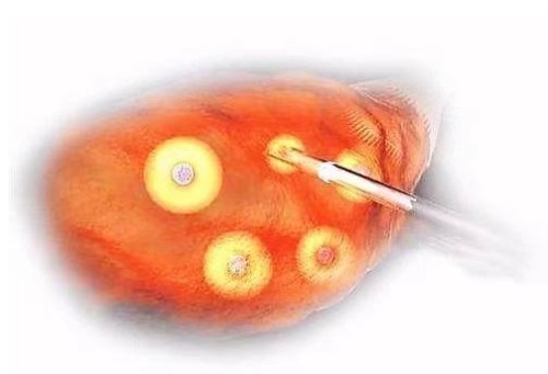 深圳正规助孕机构：导致胎停因素有哪些，除了精子还与这些原因有关