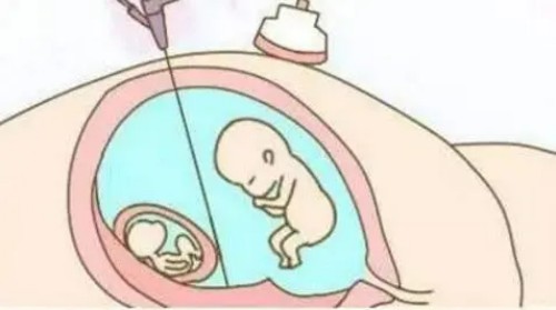 深圳试管助孕公司：热敷影响子宫收缩吗,热敷子宫有什么好处